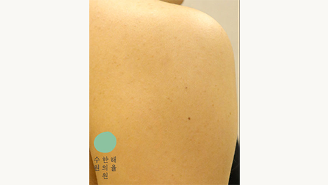 [수원점] 모공각화증 과연 일시적인 현상일까요?수원해율한의원 치료 방법 - 해율한의원