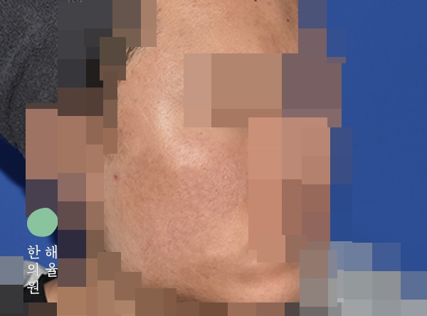 [울산점] 울산여드름자국 시간이 지나면 없어질까요? - 해율한의원
