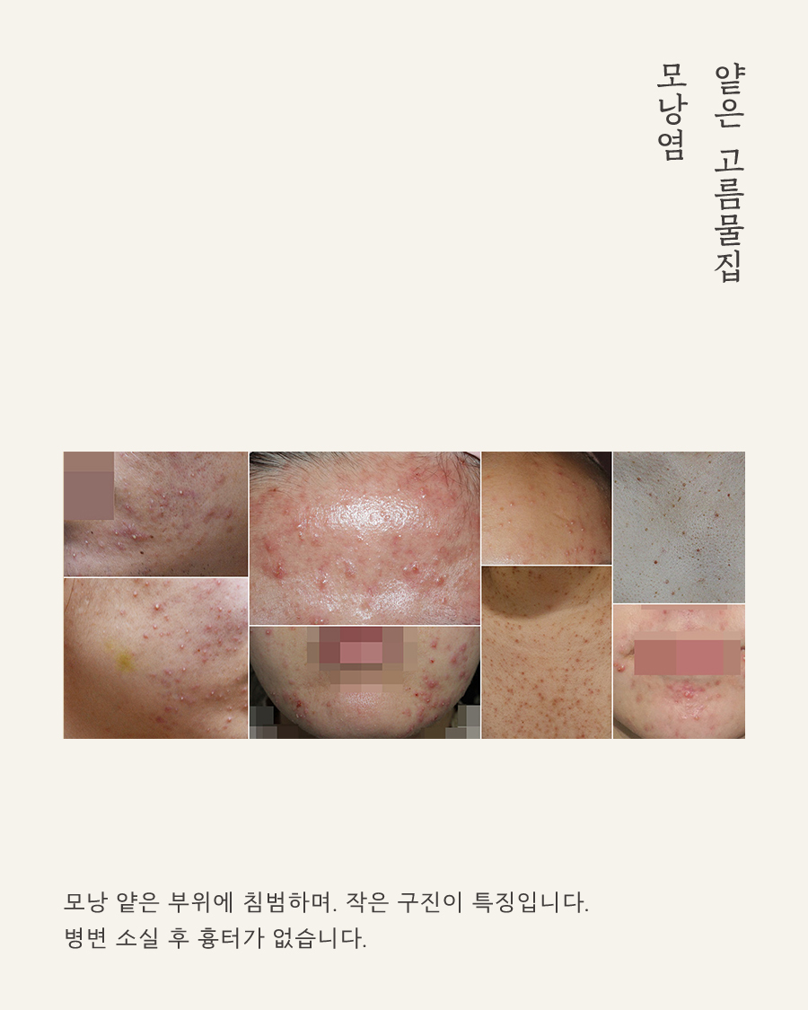 [목동점] 모낭염과 일반 여드름의 차이점 및 주 증상은 무엇인가요 - 해율한의원