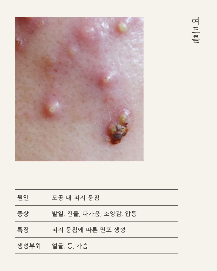 [목동점] 모낭염과 일반 여드름의 차이점 및 주 증상은 무엇인가요 - 해율한의원