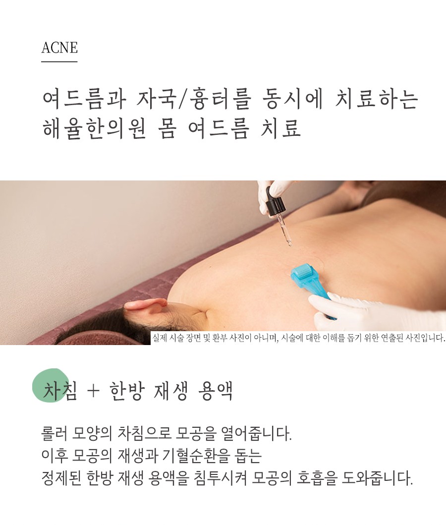 [천안점] 천안여드름자국 미세약초침 원리 및 효과에 대해 설명드립니다 - 해율한의원