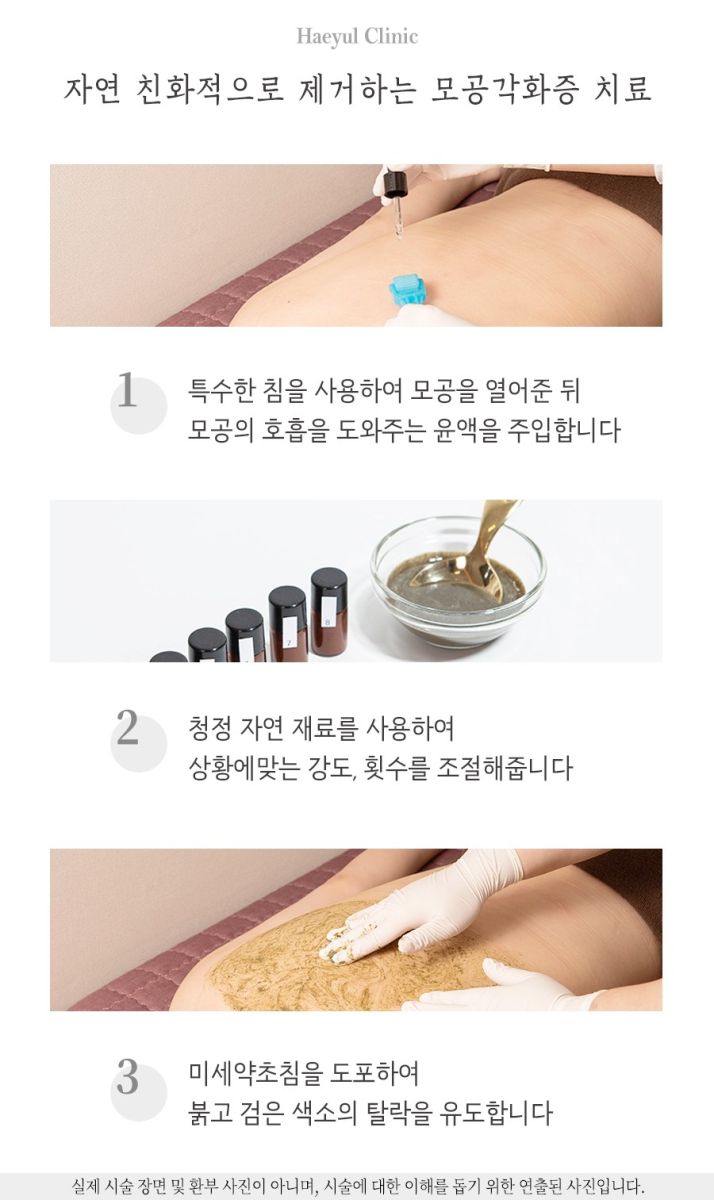 [강남점] 강남모공각화증 얼굴에도 생길 수 있나요? - 해율한의원