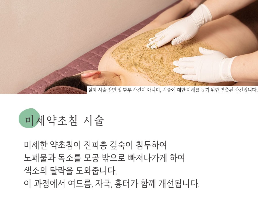 [천안점] 천안여드름자국 미세약초침 원리 및 효과에 대해 설명드립니다 - 해율한의원