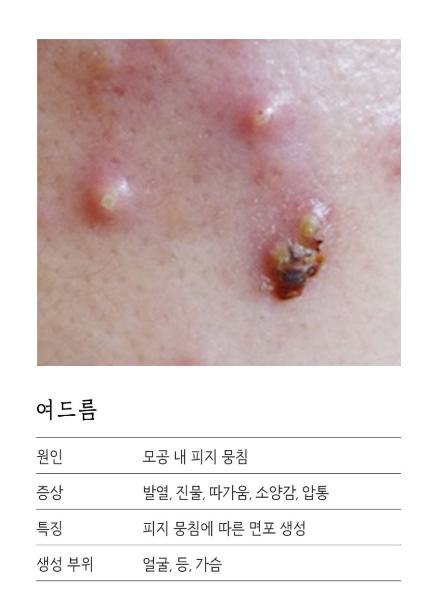 [수원점] 수원모낭염과 여드름은 어떻게 구별하나요? - 해율한의원
