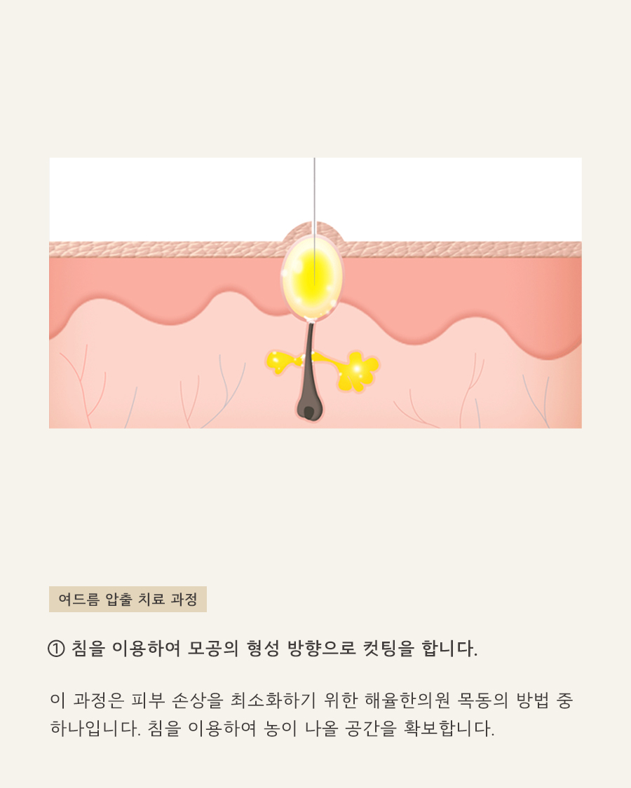 [목동점] 화곡여드름피부과 재발 막는 방법은 무엇일까요? - 해율한의원