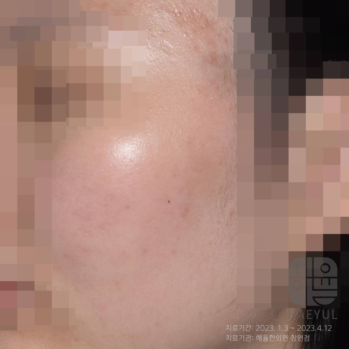 [창원점] 창원피부한의원 갑자기 얼굴이 뒤집어지는 이유는? - 해율한의원