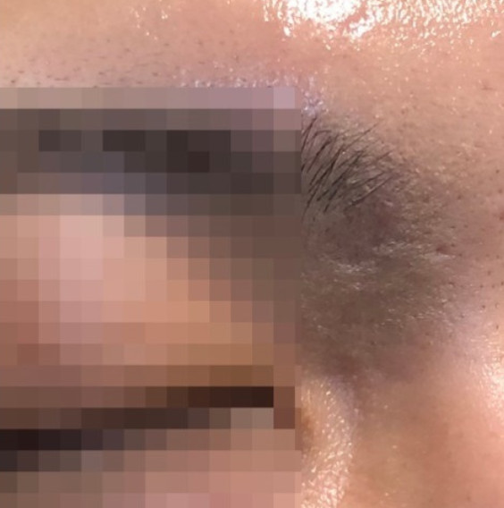 [인천점] 인천여드름흉터 새살침 시술, 붉은기는 얼마나 가나요? - 해율한의원