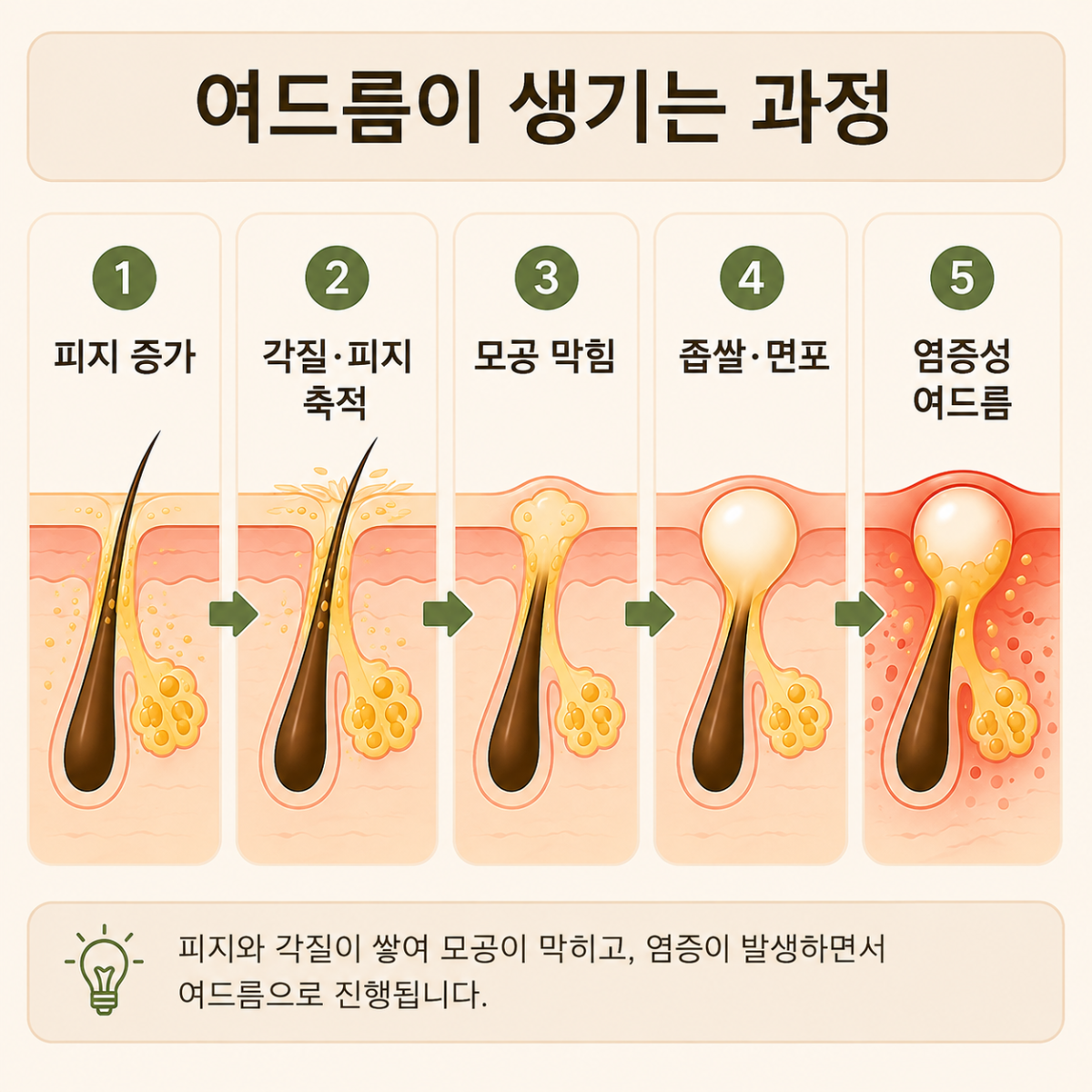 [대구점] 대구여드름피부과 한의원의 10대 여드름 치료법 - 해율한의원