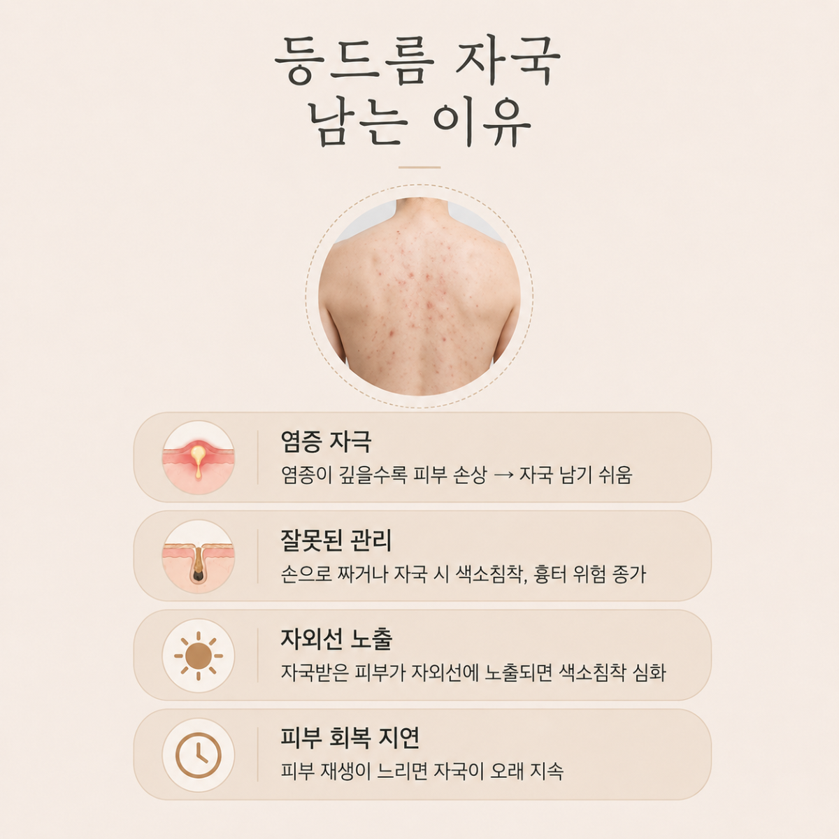 [천안점] 천안등여드름 등드름 자국 남는 이유, 치료까지 원장님이 설명드립니다 - 해율한의원