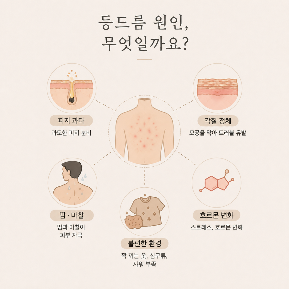 [천안점] 천안등여드름 등드름 자국 남는 이유, 치료까지 원장님이 설명드립니다 - 해율한의원