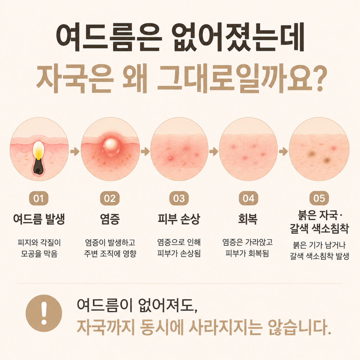 [울산점] 울산여드름자국 시간이 지나면 없어질까요? - 해율한의원