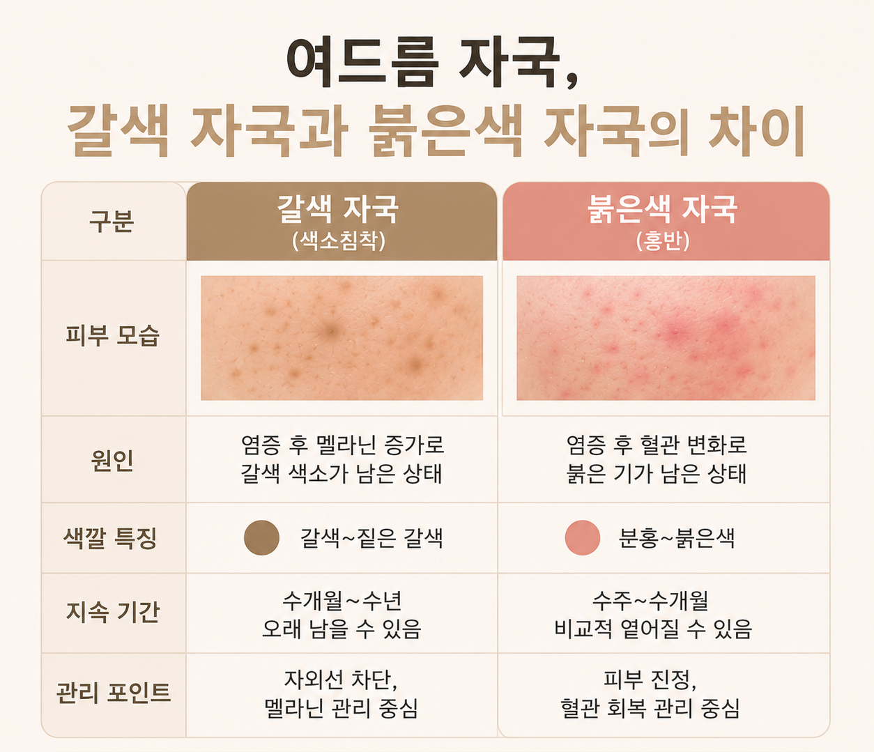 [울산점] 울산여드름자국 시간이 지나면 없어질까요? - 해율한의원