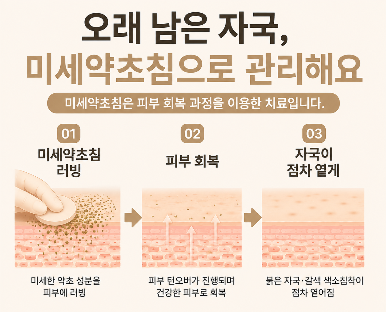 [울산점] 울산여드름자국 시간이 지나면 없어질까요? - 해율한의원