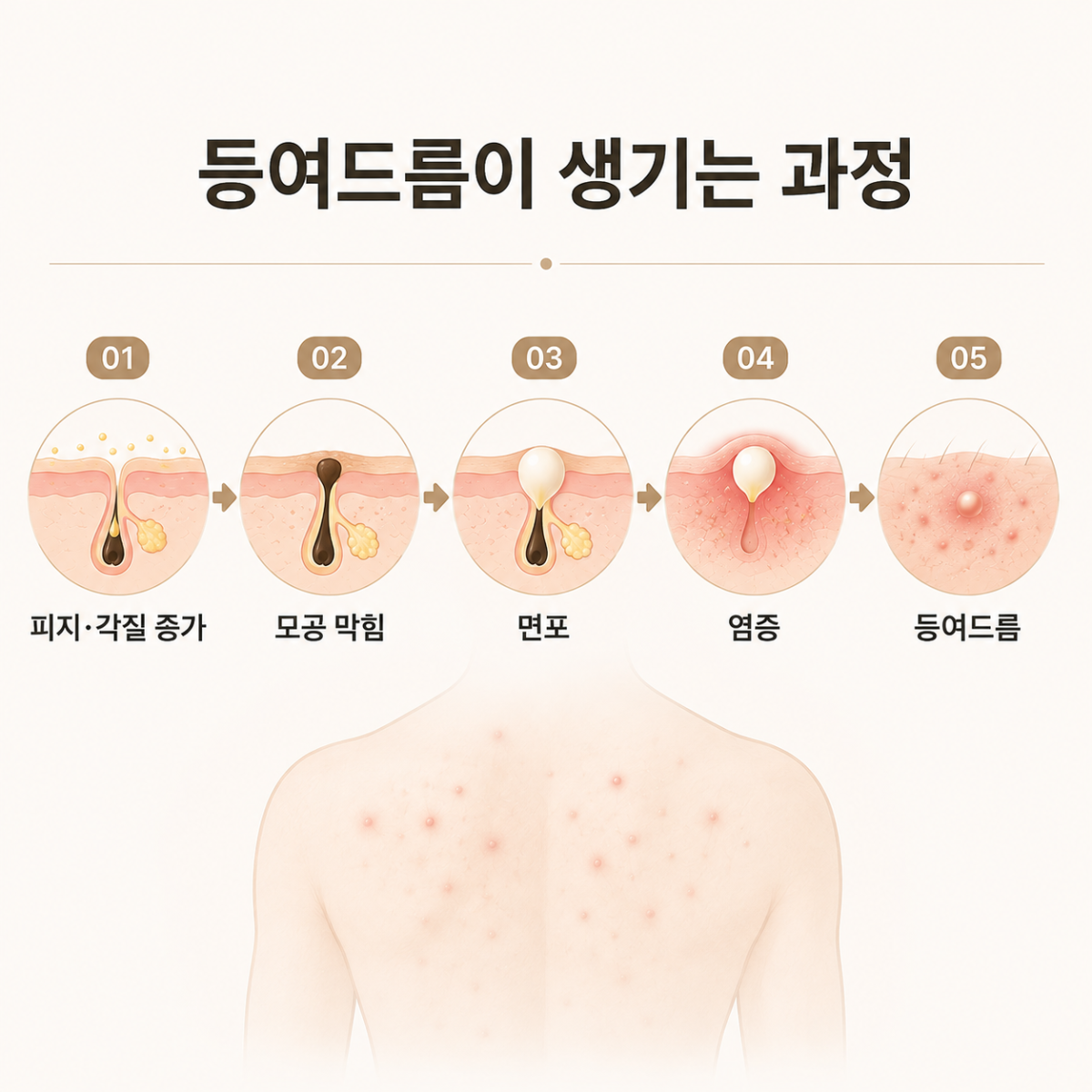 [강남점] 강남등여드름 샤워 후 관리도 중요한 이유 - 해율한의원