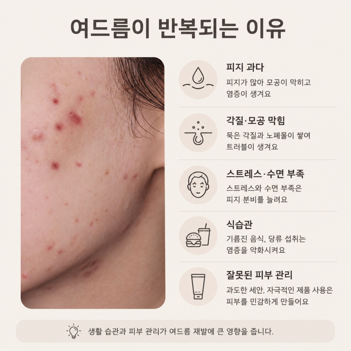 [홍대점] 홍대여드름피부과 화농성 여드름 같은 자리에 반복되는 이유는? - 해율한의원