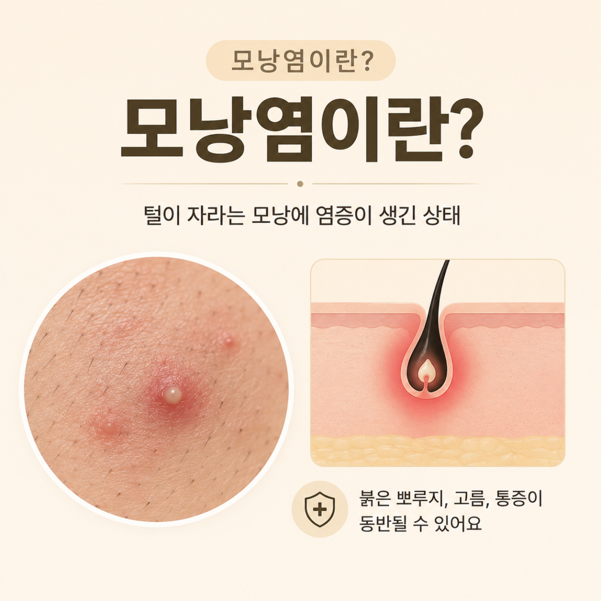 [목동점] 목동모낭염 재발한다면 확인해야 할 것들 - 해율한의원