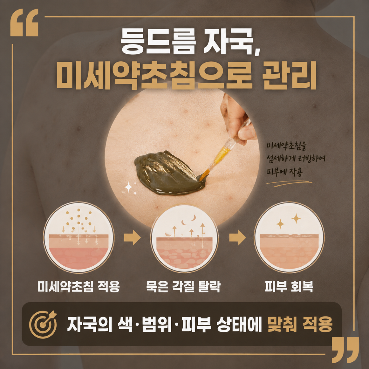 [울산점] 울산등여드름 갑자기 늘었다면 확인해볼 것들 - 해율한의원