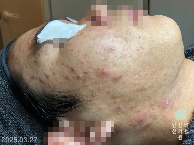 [인천점] [인천 해율한의원] 얼굴, 목 결절성 여드름 치료 케이스 - 해율한의원