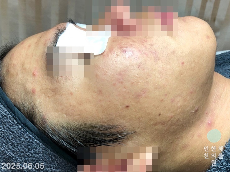 [인천점] [인천 해율한의원] 얼굴, 목 결절성 여드름 치료 케이스 - 해율한의원