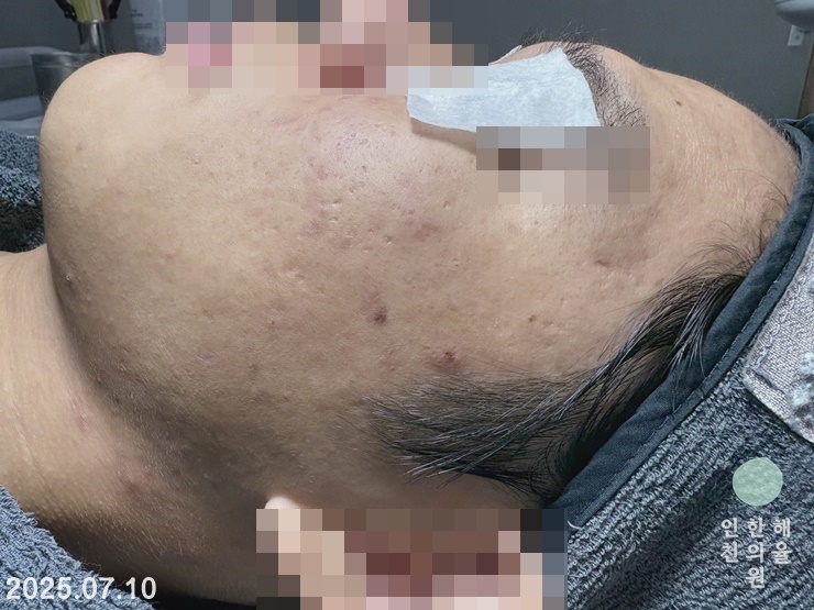 [인천점] [인천 해율한의원] 얼굴, 목 결절성 여드름 치료 케이스 - 해율한의원