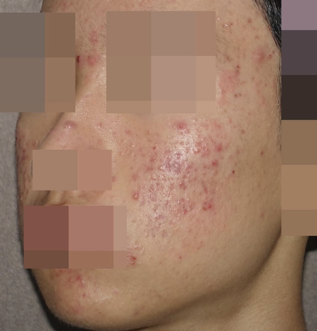 [홍대점] 홍대피부한의원 좁쌀부터 염증성 여드름까지 종류별 특징 설명드립니다 - 해율한의원