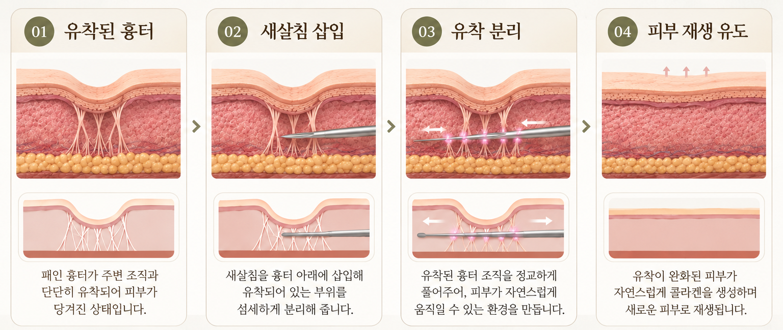 [수원점] 20년 이상 오래된 흉터도 새살침으로 채울 수 있나요? - 해율한의원