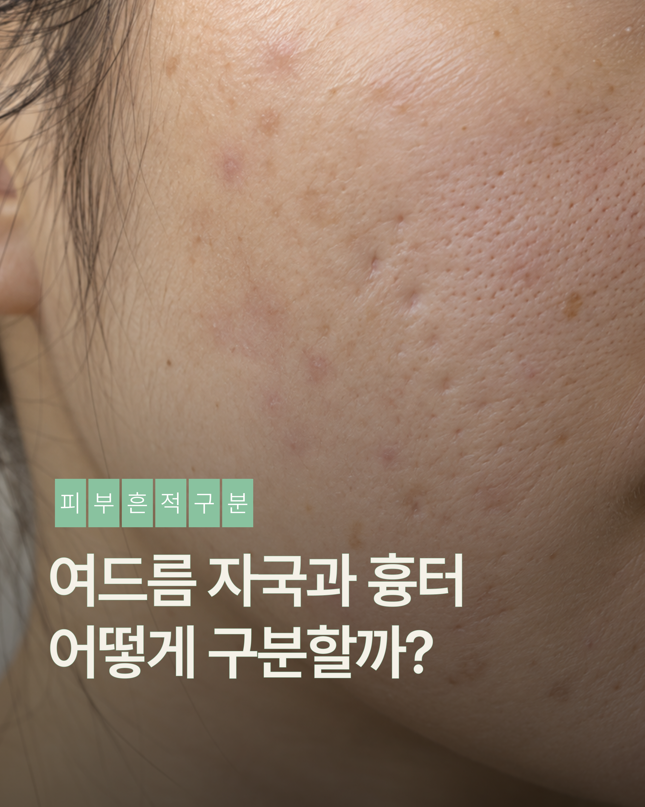 [수원점] 여드름 자국과 흉터 어떻게 구분할까요? - 해율한의원